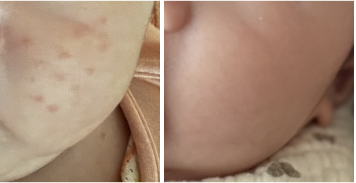 아기 태열 피부 이미지